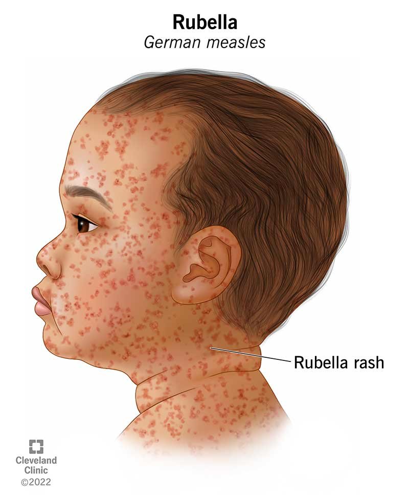 Rubella Antibodies